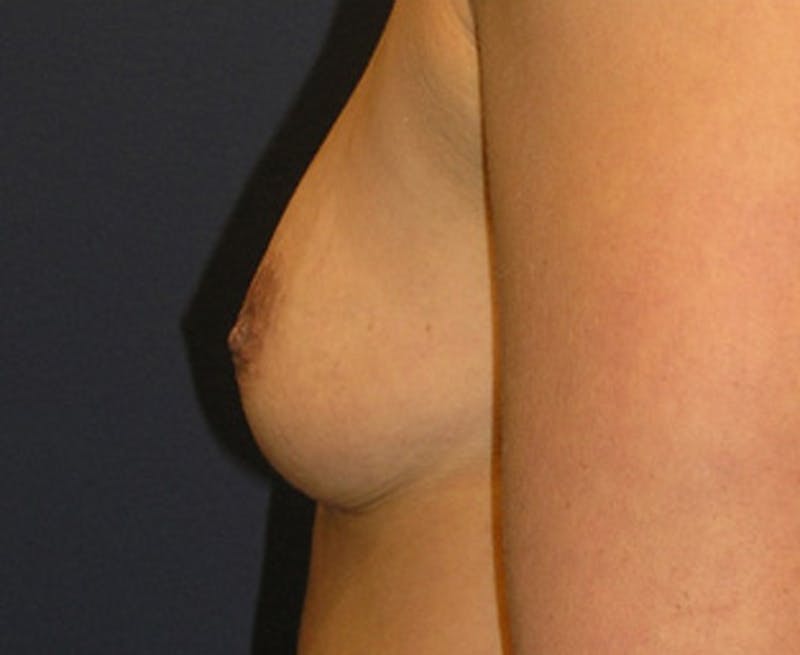 Breast Augmentation Before & After Gallery - Patient 174163169 - Image 5