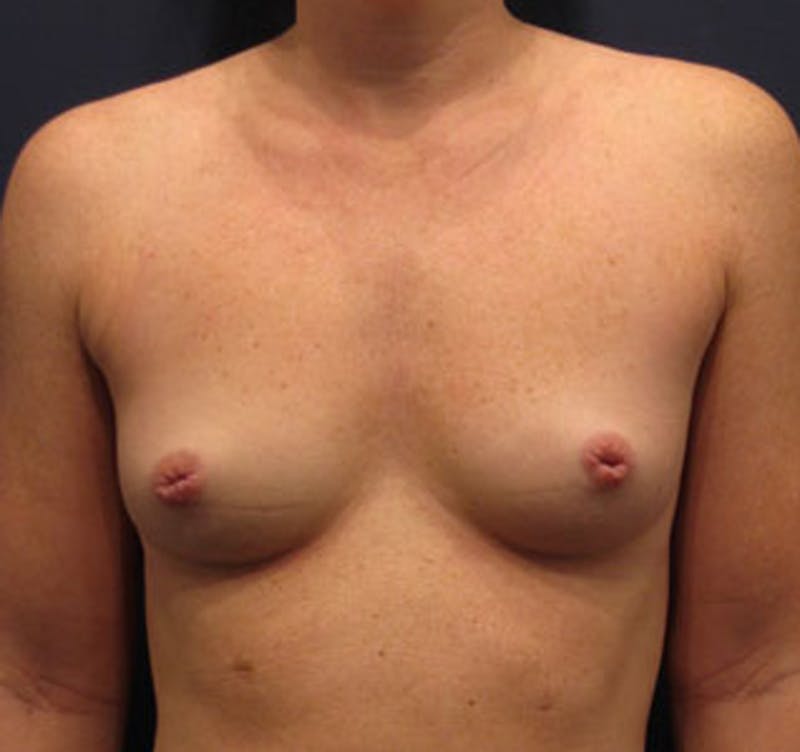 Breast Augmentation Before & After Gallery - Patient 174163176 - Image 1