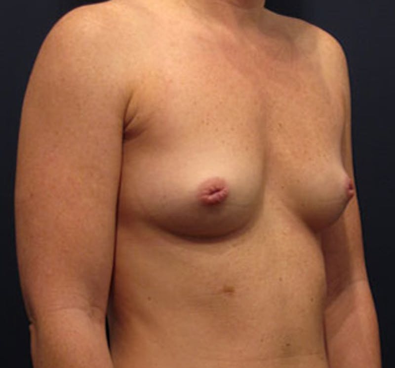 Breast Augmentation Before & After Gallery - Patient 174163176 - Image 3