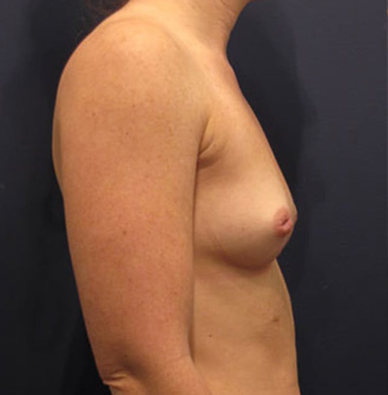 Breast Augmentation Before & After Gallery - Patient 174163176 - Image 5