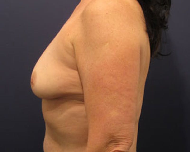 Breast Augmentation Before & After Gallery - Patient 174163182 - Image 3