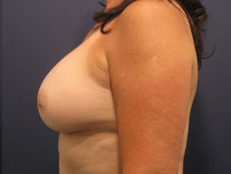 Breast Augmentation Before & After Gallery - Patient 174163182 - Image 4