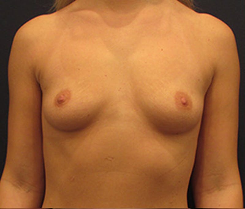 Breast Augmentation Before & After Gallery - Patient 174163188 - Image 1