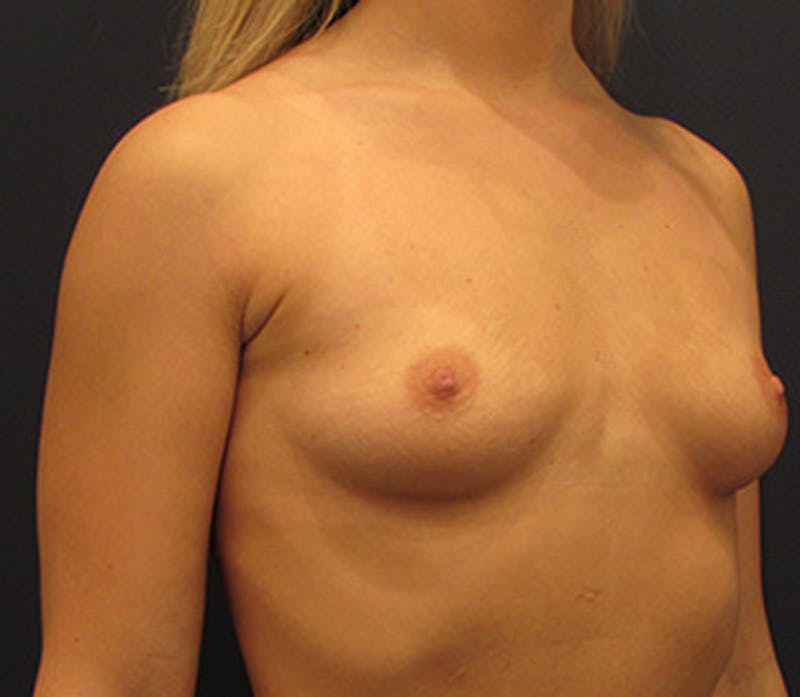 Breast Augmentation Before & After Gallery - Patient 174163188 - Image 5