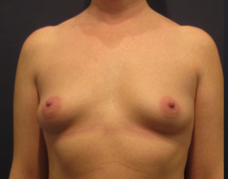Breast Augmentation Before & After Gallery - Patient 174163194 - Image 1