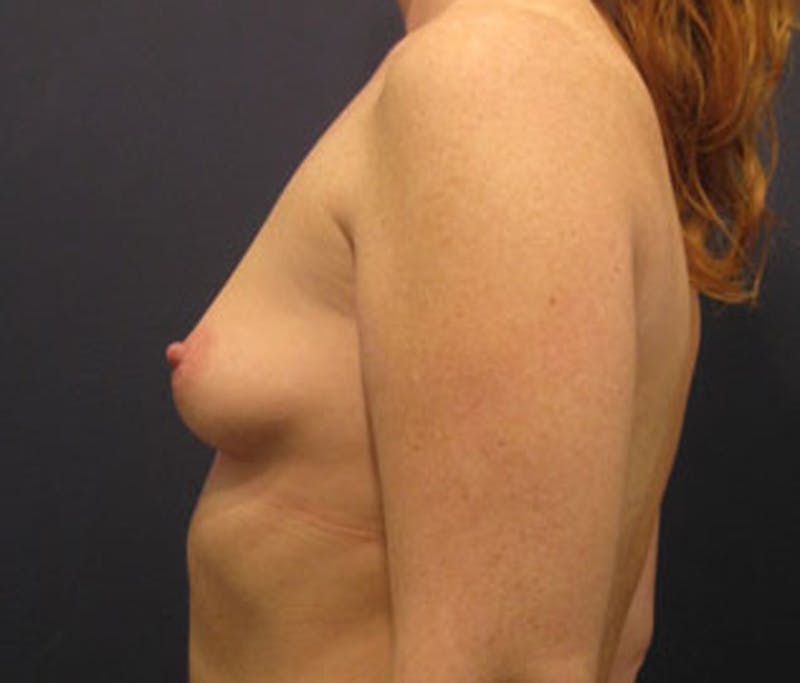 Breast Augmentation Before & After Gallery - Patient 174163194 - Image 3