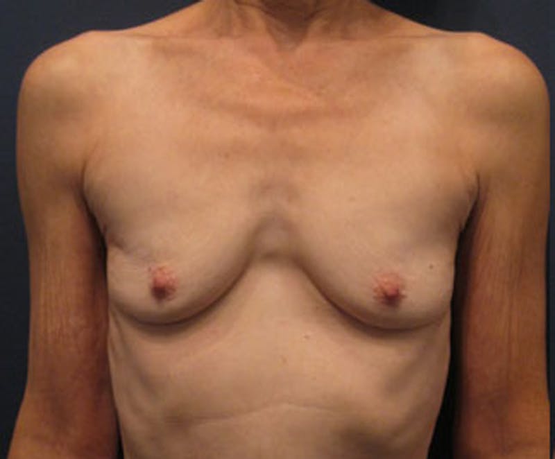 Breast Augmentation Before & After Gallery - Patient 174163199 - Image 1