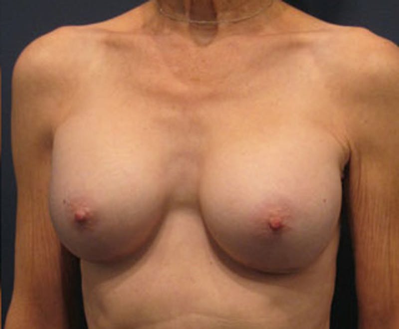 Breast Augmentation Before & After Gallery - Patient 174163199 - Image 2