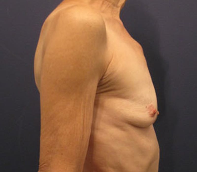 Breast Augmentation Before & After Gallery - Patient 174163199 - Image 3