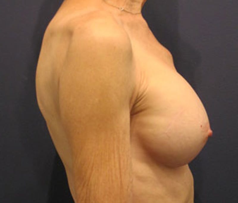 Breast Augmentation Before & After Gallery - Patient 174163199 - Image 4