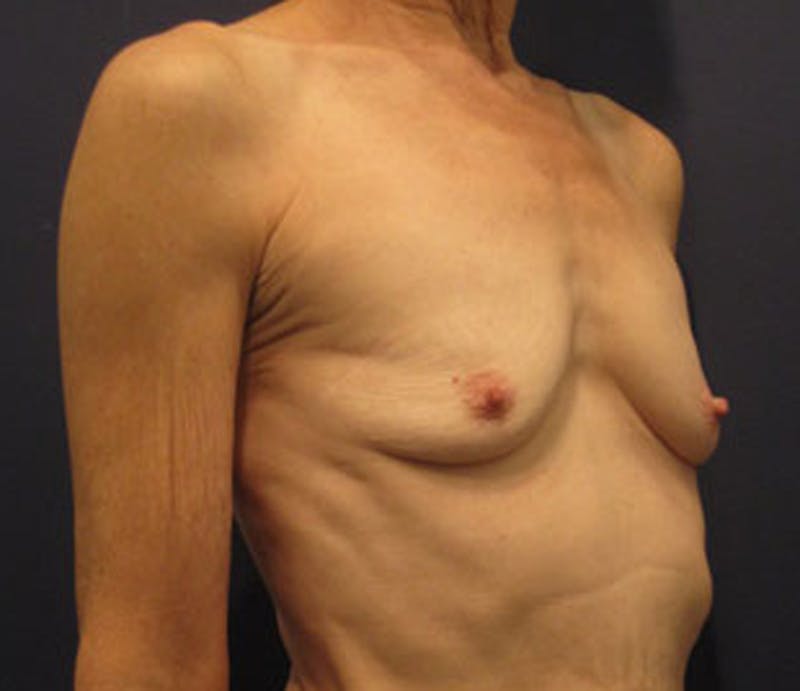 Breast Augmentation Before & After Gallery - Patient 174163199 - Image 5