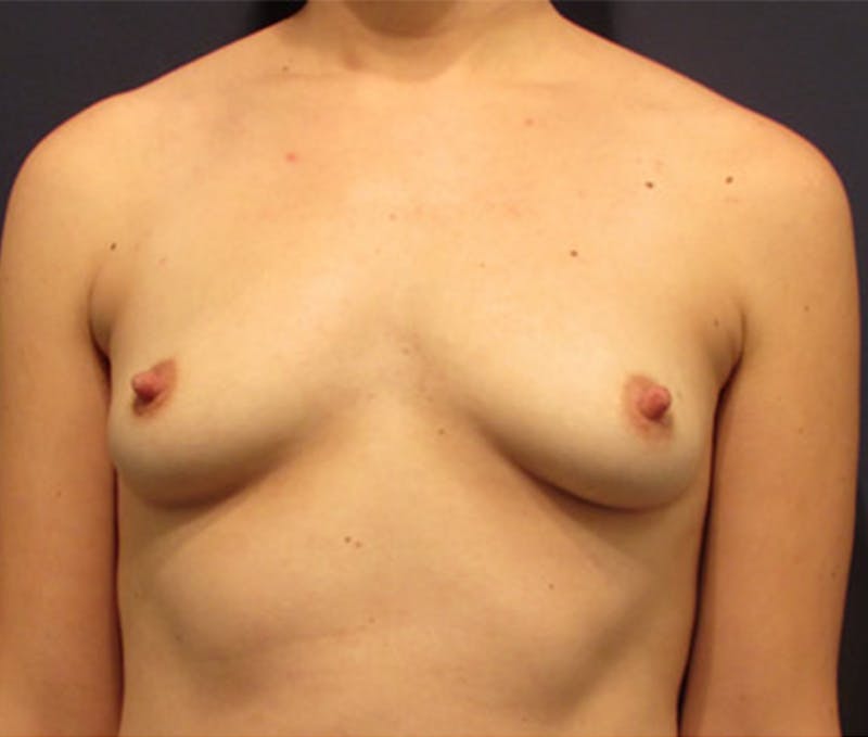 Breast Augmentation Before & After Gallery - Patient 174163225 - Image 1