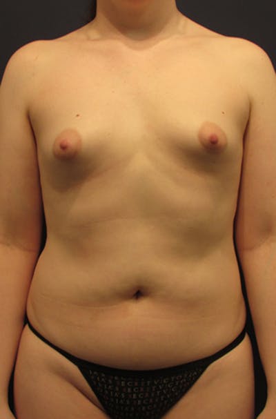 Breast Augmentation Before & After Gallery - Patient 174163237 - Image 1