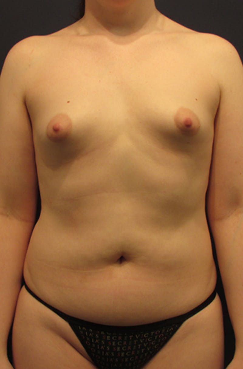Breast Augmentation Before & After Gallery - Patient 174163237 - Image 1