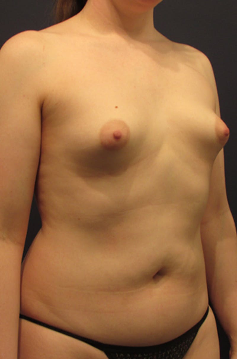 Breast Augmentation Before & After Gallery - Patient 174163237 - Image 3