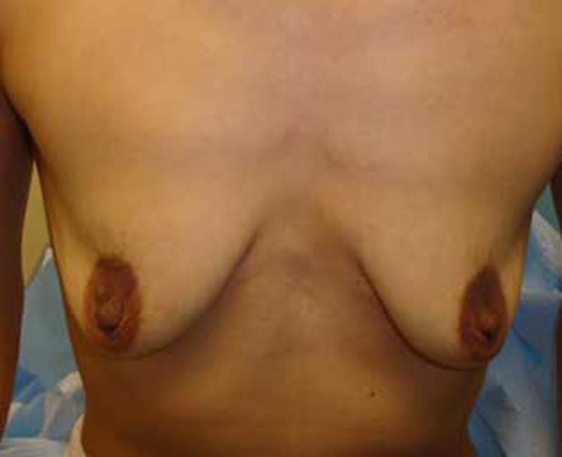 Breast Augmentation Before & After Gallery - Patient 174163253 - Image 1