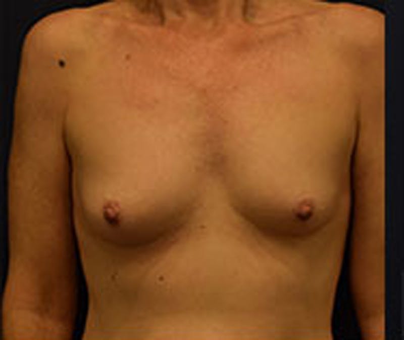Breast Augmentation Before & After Gallery - Patient 174163258 - Image 1