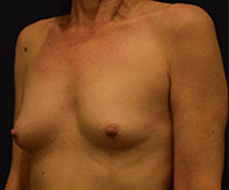 Breast Augmentation Before & After Gallery - Patient 174163258 - Image 3