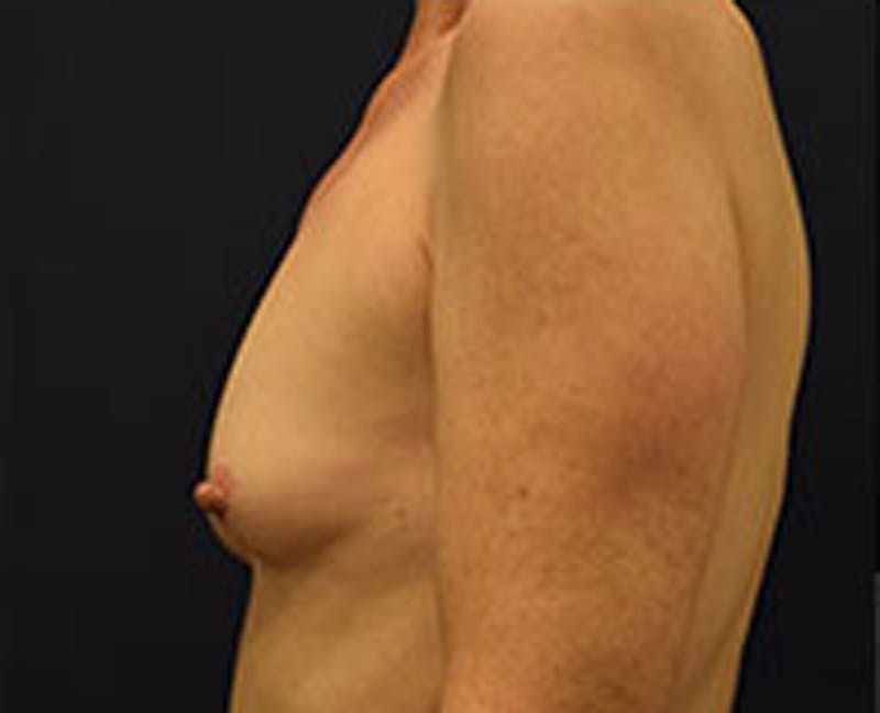 Breast Augmentation Before & After Gallery - Patient 174163258 - Image 5