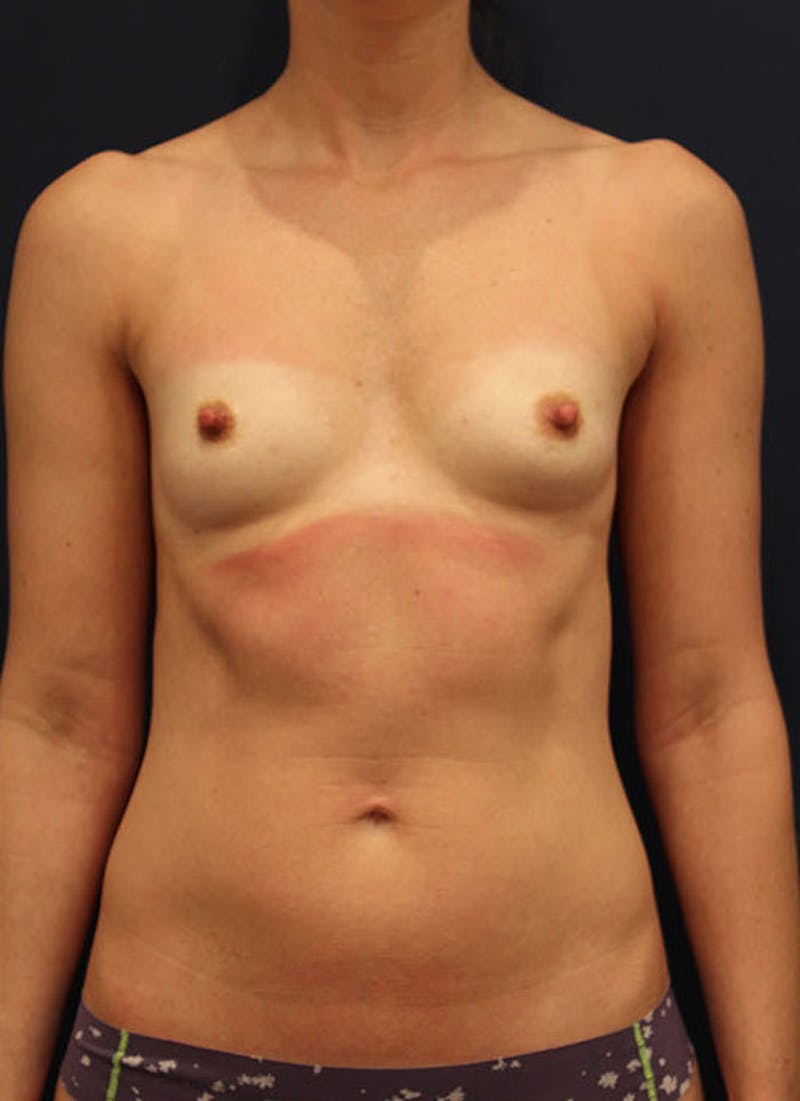 Breast Augmentation Before & After Gallery - Patient 174163264 - Image 1