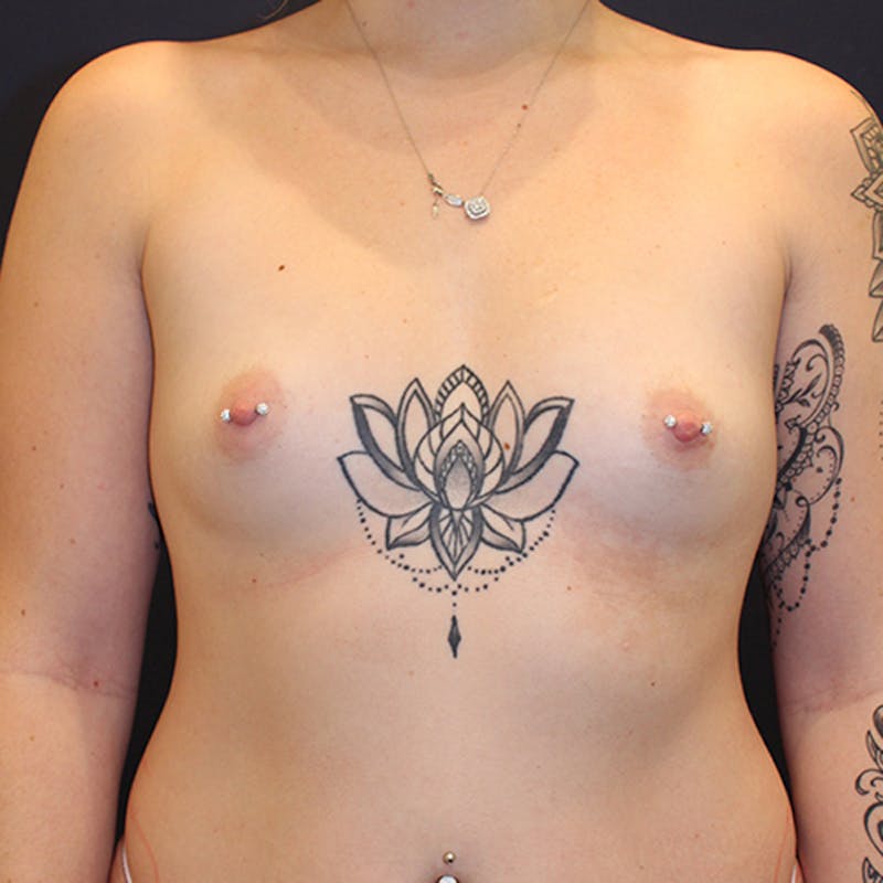 Breast Augmentation Before & After Gallery - Patient 174164398 - Image 1