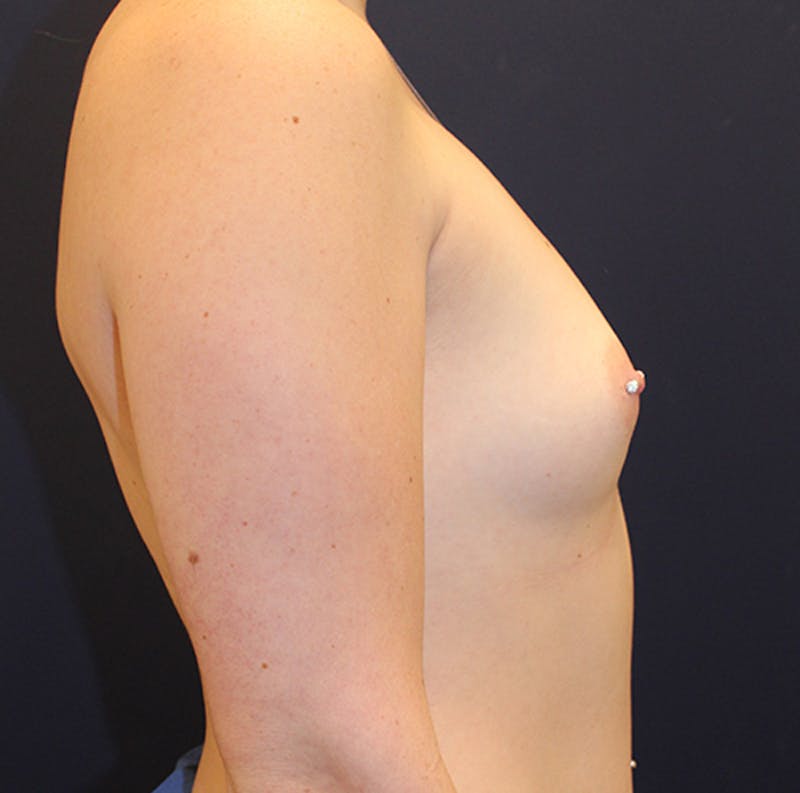 Breast Augmentation Before & After Gallery - Patient 174164398 - Image 5
