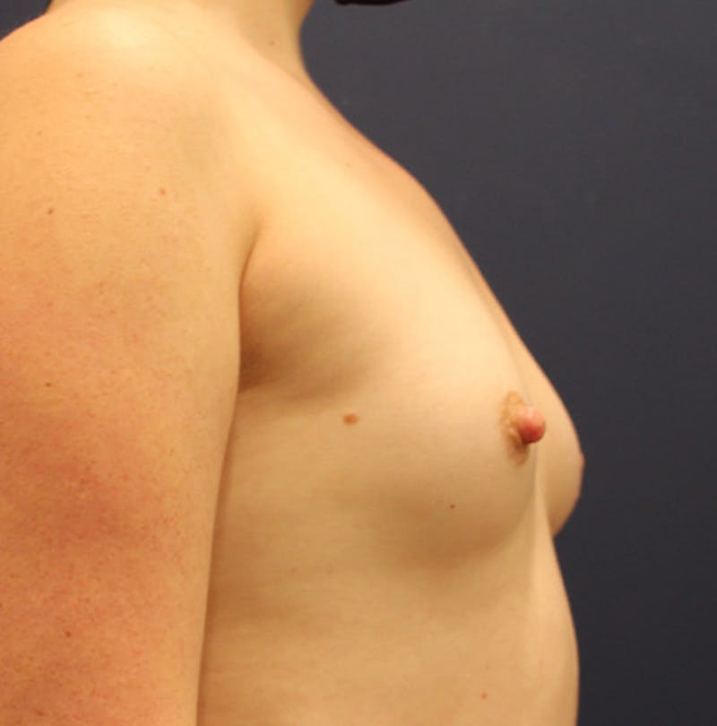 Breast Augmentation Before & After Gallery - Patient 174164418 - Image 5