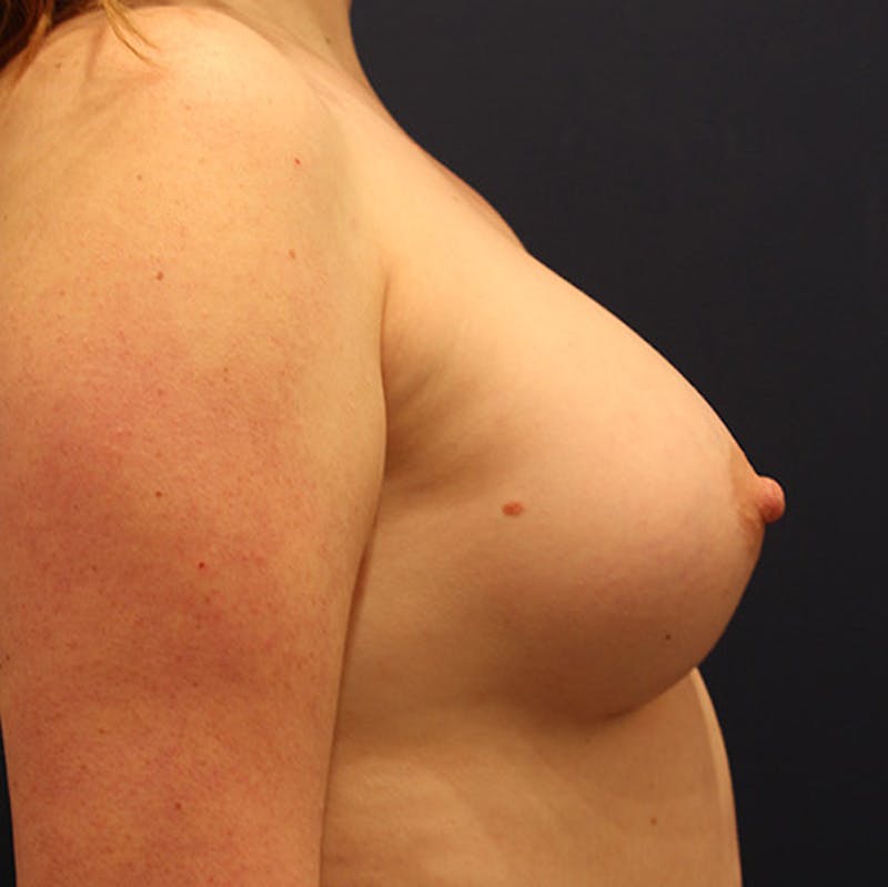 Breast Augmentation Before & After Gallery - Patient 174164418 - Image 6