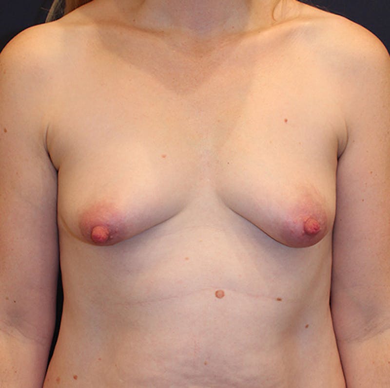 Breast Augmentation Before & After Gallery - Patient 174200029 - Image 1