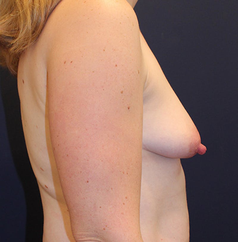 Breast Augmentation Before & After Gallery - Patient 174200029 - Image 5
