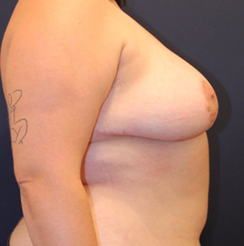 Breast Asymmetry Before & After Gallery - Patient 174146568 - Image 10
