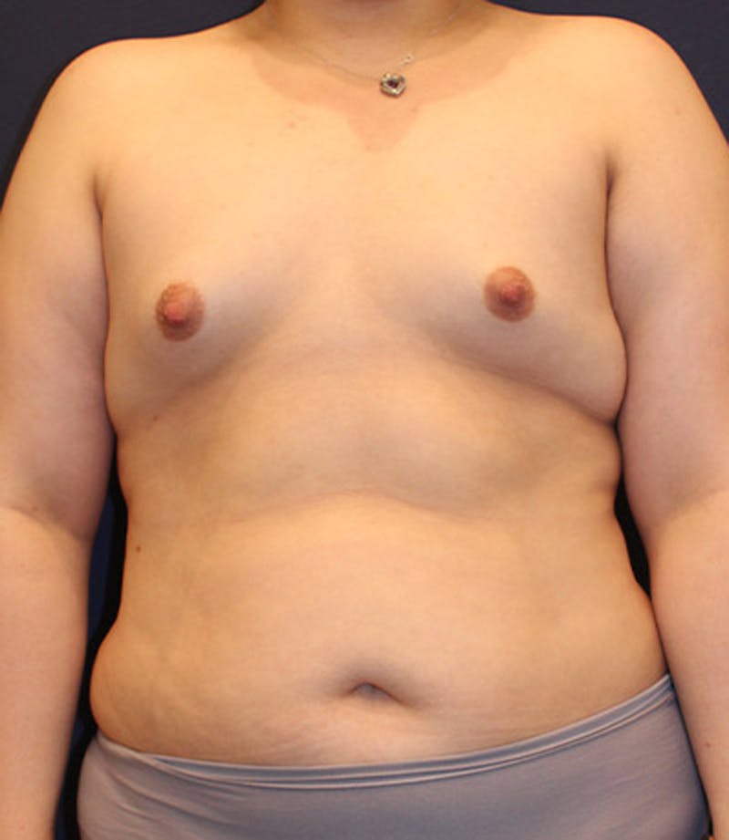 Breast Asymmetry Before & After Gallery - Patient 174146572 - Image 1