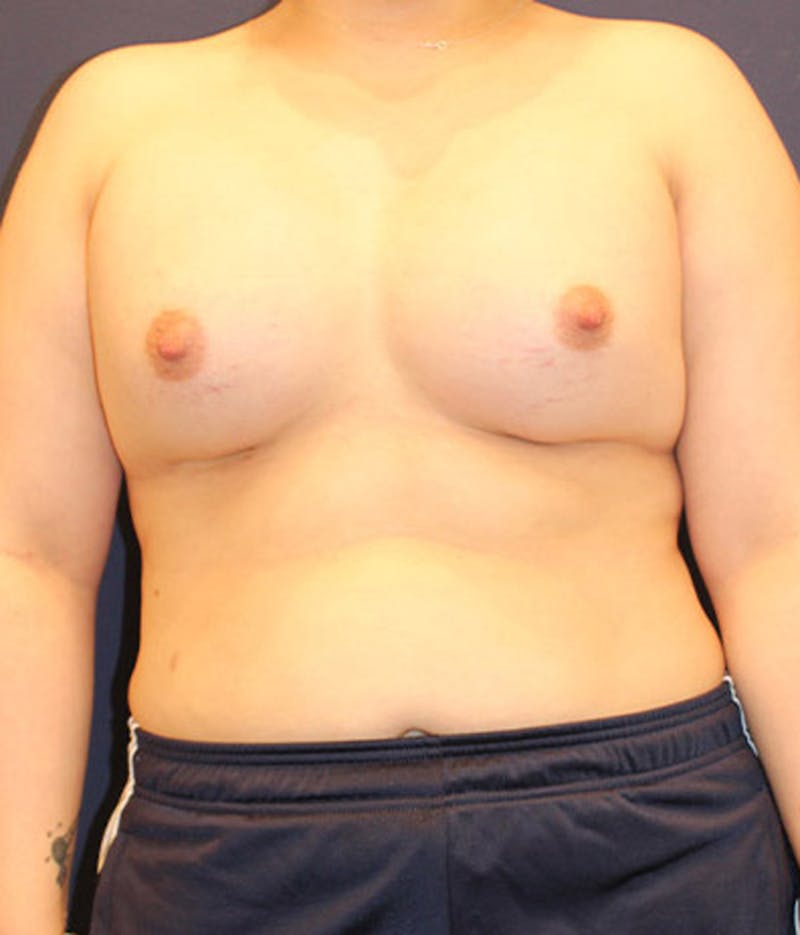 Breast Asymmetry Before & After Gallery - Patient 174146572 - Image 2