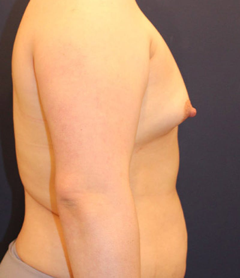 Breast Asymmetry Before & After Gallery - Patient 174146572 - Image 5