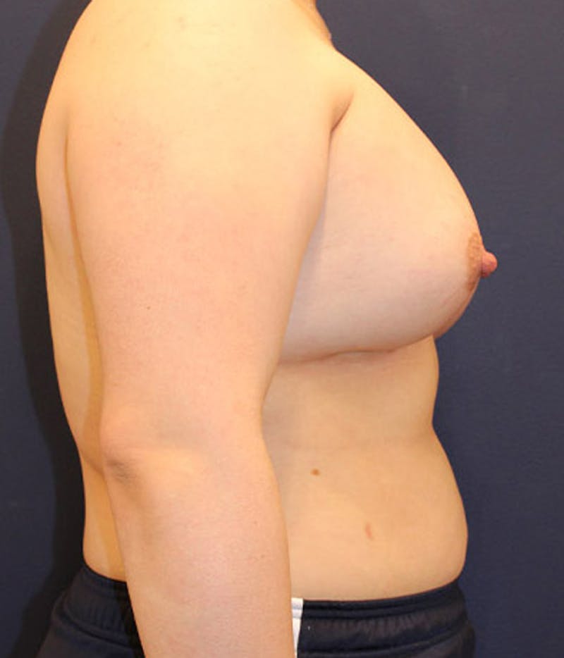 Breast Asymmetry Before & After Gallery - Patient 174146572 - Image 6