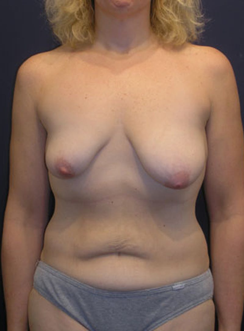 Breast Asymmetry Before & After Gallery - Patient 174146579 - Image 1