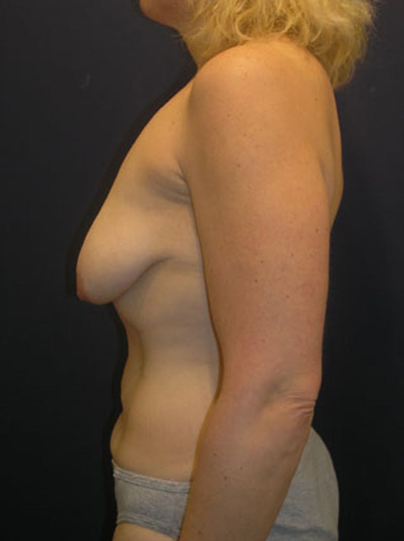 Breast Asymmetry Before & After Gallery - Patient 174146579 - Image 5