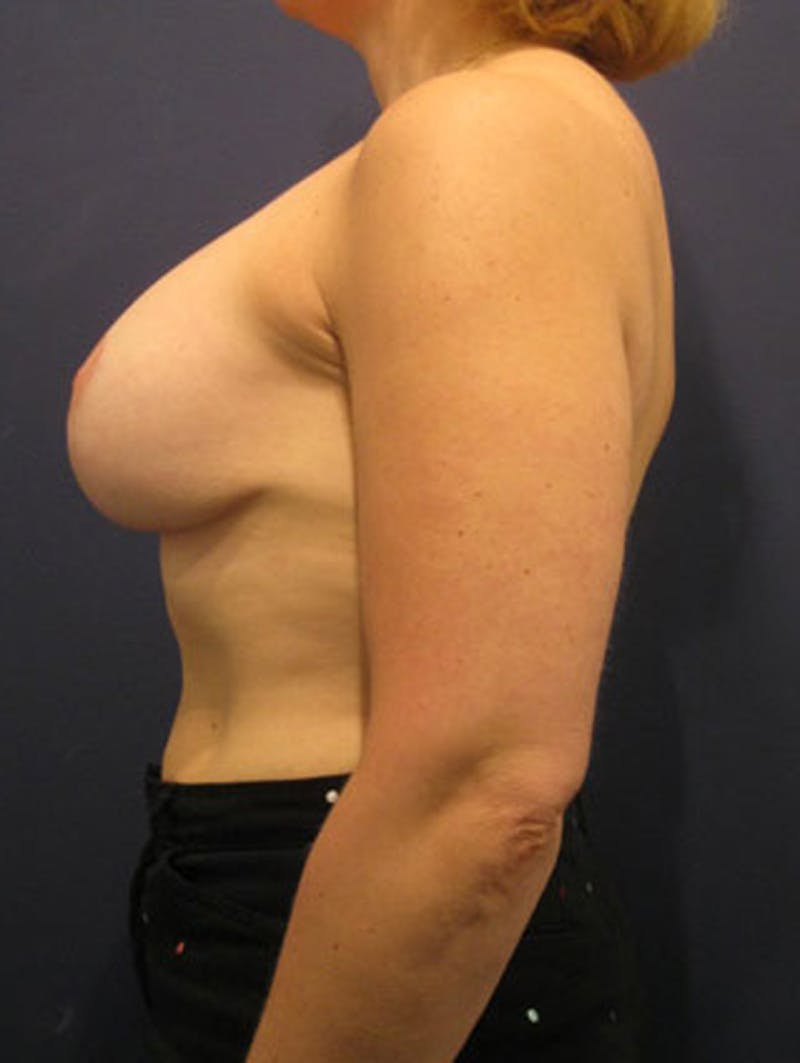 Breast Asymmetry Before & After Gallery - Patient 174146579 - Image 6