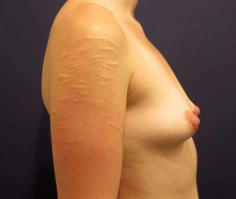 Breast Asymmetry Before & After Gallery - Patient 174146583 - Image 3