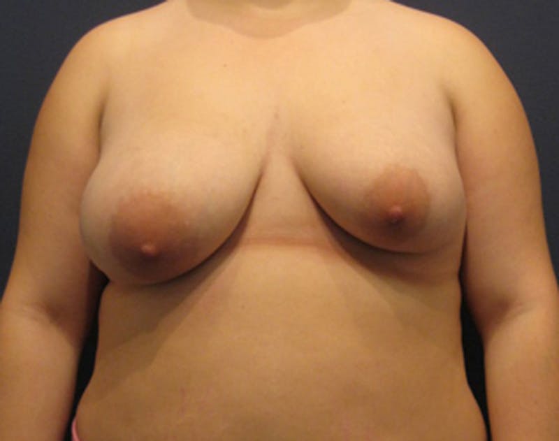 Breast Asymmetry Before & After Gallery - Patient 174146588 - Image 1