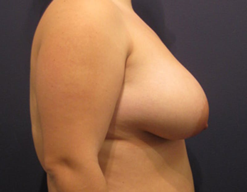 Breast Asymmetry Before & After Gallery - Patient 174146588 - Image 5