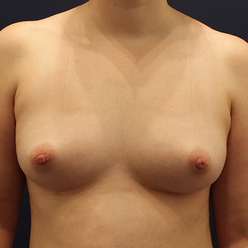 Fat Grafting Before & After Gallery - Patient 174146571 - Image 2