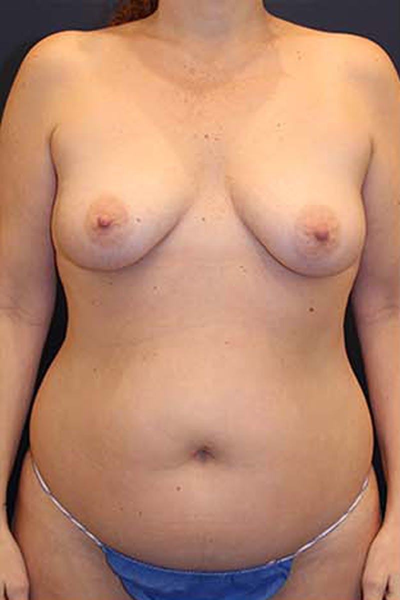 Fat Grafting Before & After Gallery - Patient 174146581 - Image 1