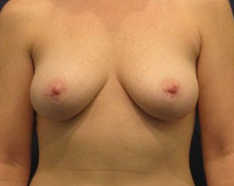 Fat Grafting Before & After Gallery - Patient 174146586 - Image 1