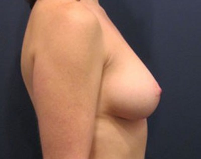 Fat Grafting Before & After Gallery - Patient 174146586 - Image 3