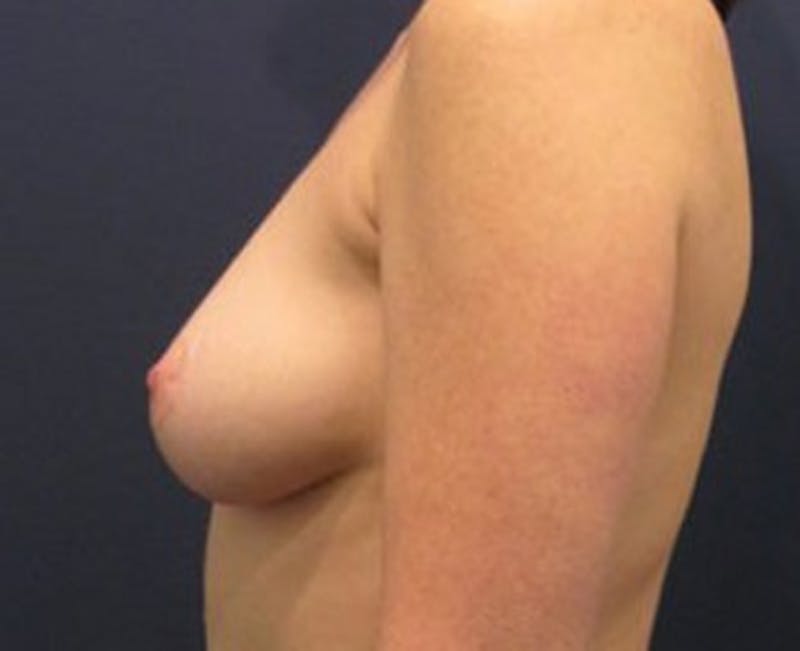 Fat Grafting Before & After Gallery - Patient 174146586 - Image 5