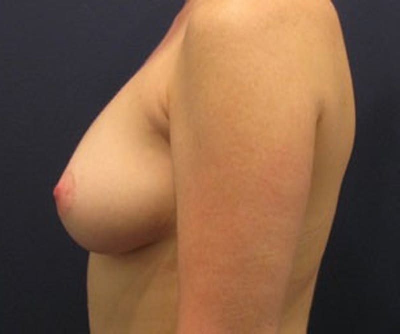 Fat Grafting Before & After Gallery - Patient 174146586 - Image 6