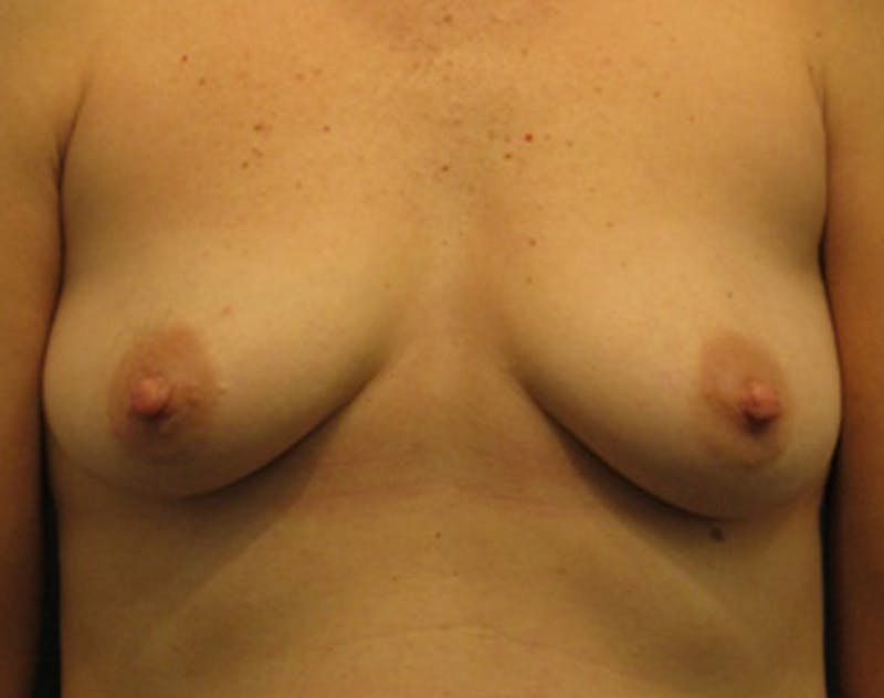 Fat Grafting Before & After Gallery - Patient 174146591 - Image 1