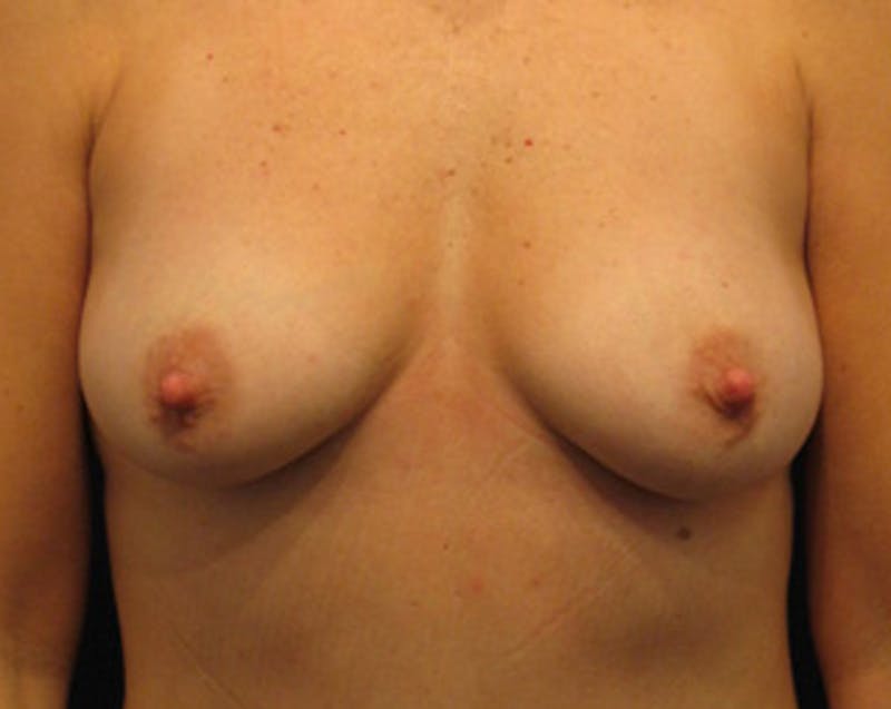 Fat Grafting Before & After Gallery - Patient 174146591 - Image 2