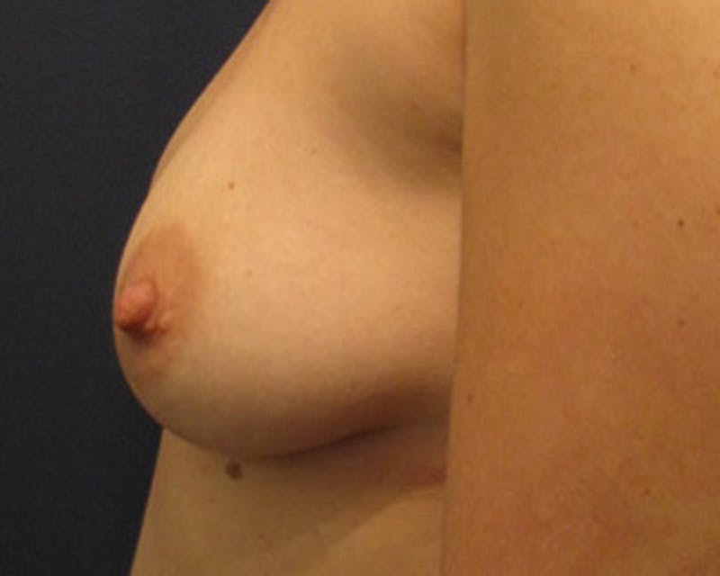 Fat Grafting Before & After Gallery - Patient 174146591 - Image 3